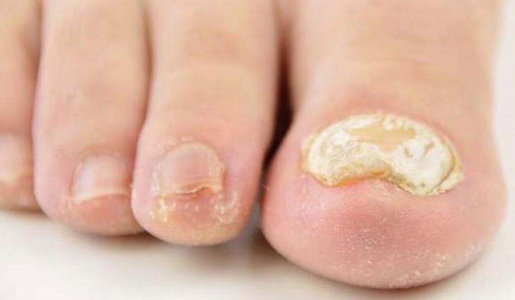 درمان سریع قارچ ناخن