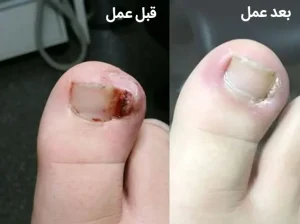 فرو رفته در گوشت پا