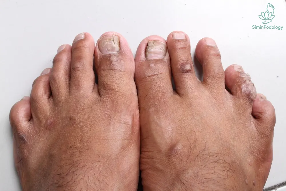 مراقبت از پاهای دیابتی