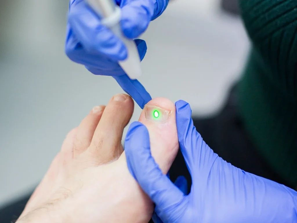 درمان ناخن قارچ زده