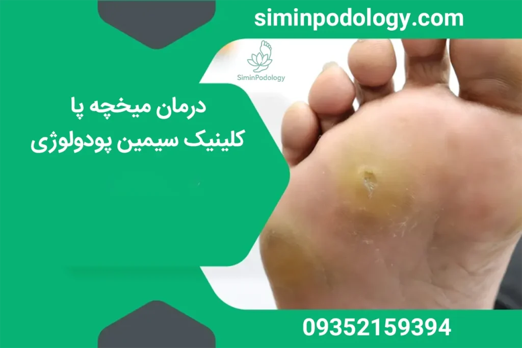 درمان میخچه پا