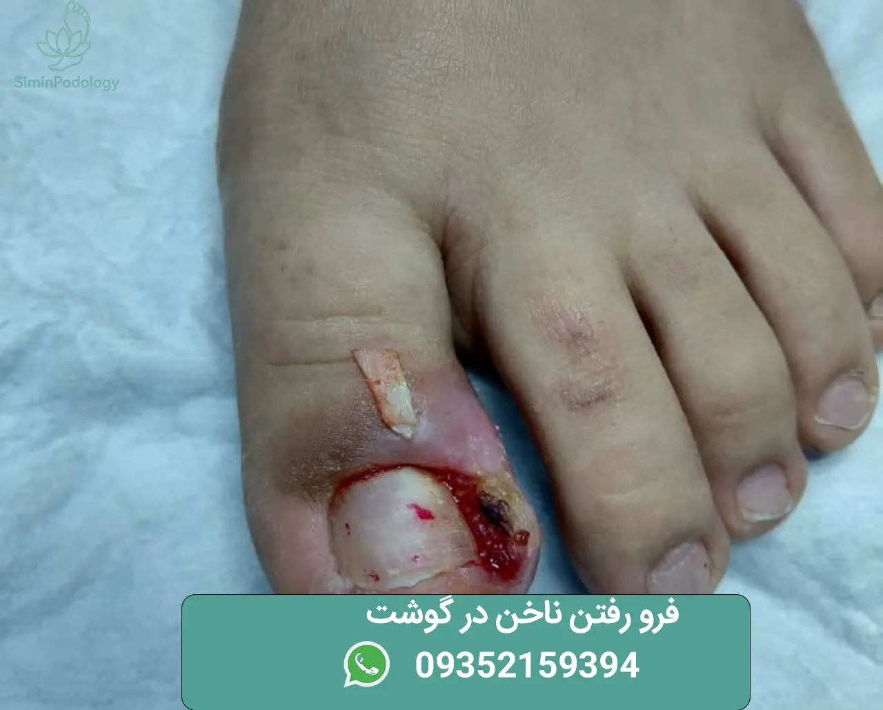 فرو رفتن ناخن در گوشت