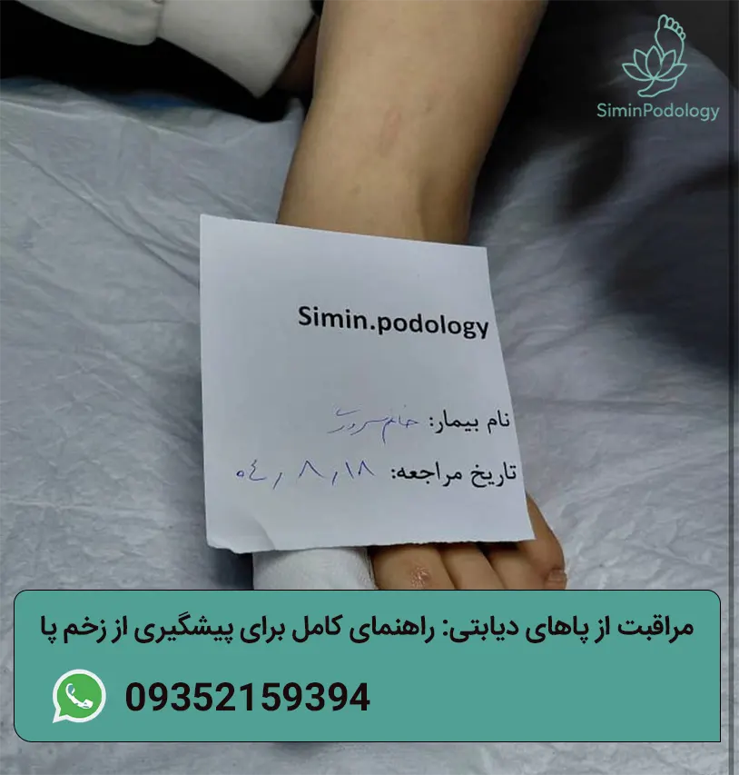 راهنمای کامل برای پیشگیری از زخم پا