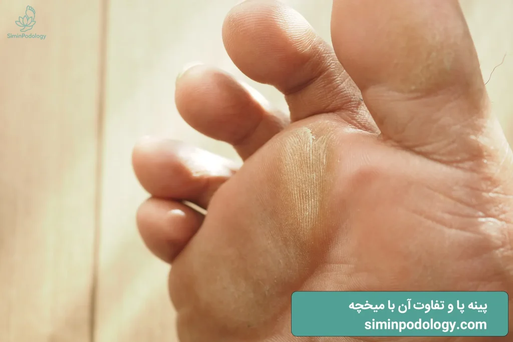 پینه پا و تفاوت آن با میخچه 